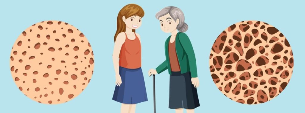 imagen freepik osteoporosis